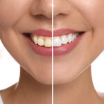 3 Clareador Dental Power Bleaching 22% BM4 + Moldeira - Imagem 4