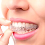 Moldeira em Silicone Para Clareamento Dental 1 Par - Imagem 3
